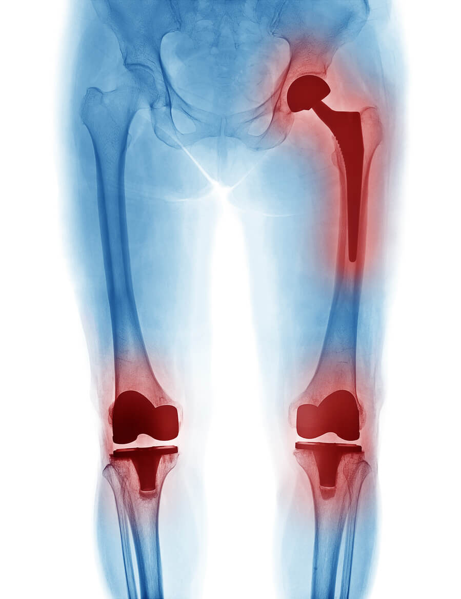 xray showing exactech knee and hip placements